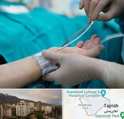 آنژیوگرافی در زعفرانیه 