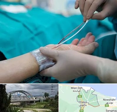 آنژیوگرافی در چالوس