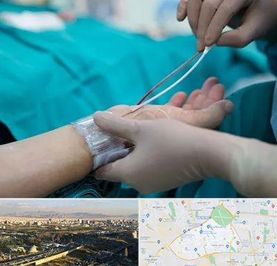 آنژیوگرافی در منطقه 19 تهران