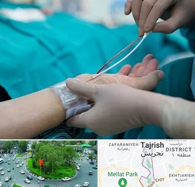 آنژیوگرافی در تجریش 