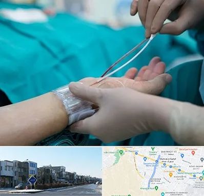 آنژیوگرافی در شریعتی مشهد