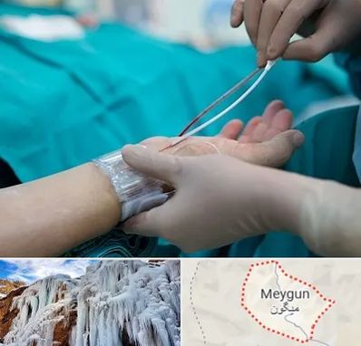 آنژیوگرافی در میگون