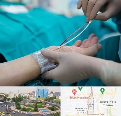 آنژیوگرافی در ونک 