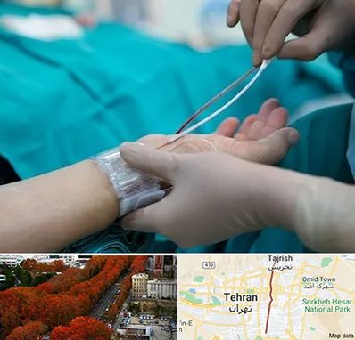 آنژیوگرافی در ولیعصر 