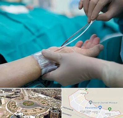 آنژیوگرافی در پرند