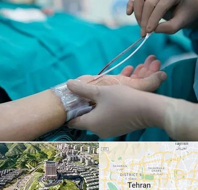آنژیوگرافی در شمال تهران 