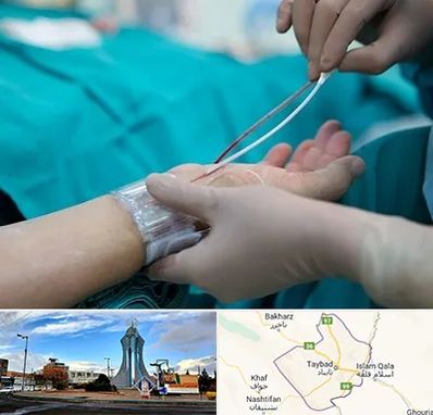 آنژیوگرافی در تایباد