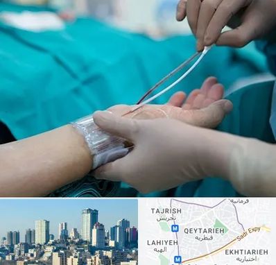 آنژیوگرافی در قیطریه 