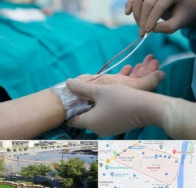 آنژیوگرافی در گلستان اهواز