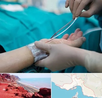 آنژیوگرافی در هرمزگان
