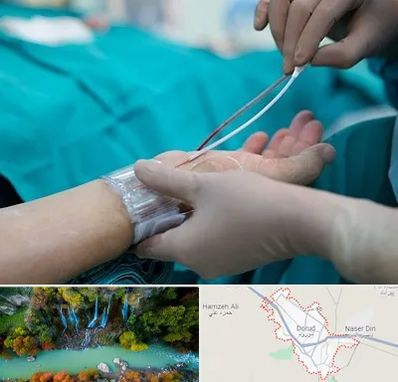 آنژیوگرافی در دورود