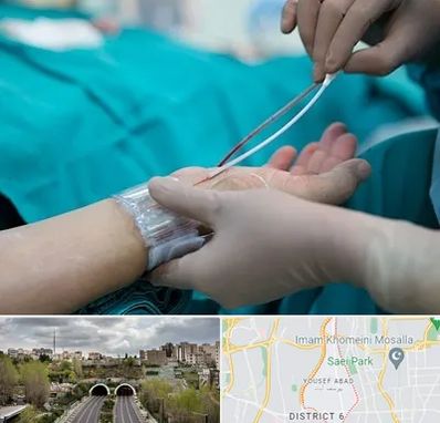 آنژیوگرافی در یوسف آباد 