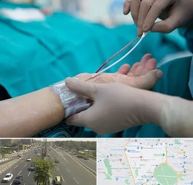 آنژیوگرافی در منطقه 17 تهران