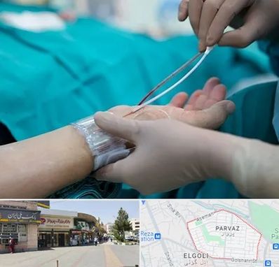 آنژیوگرافی در پرواز تبریز