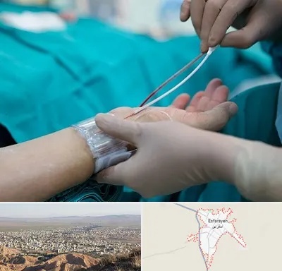 آنژیوگرافی در اسفراین