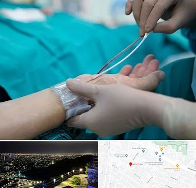 آنژیوگرافی در هفت تیر مشهد