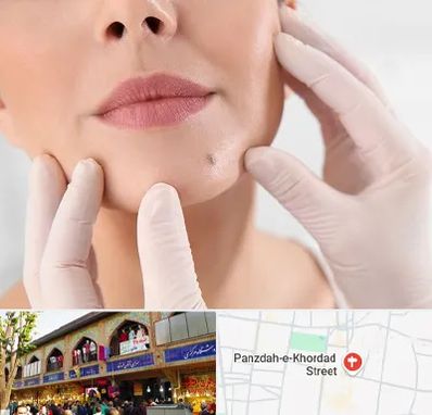 برداشتن خال در 15 خرداد