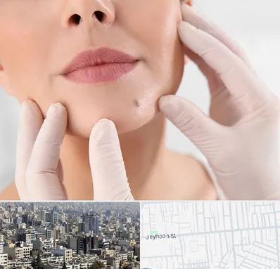 برداشتن خال در جیحون