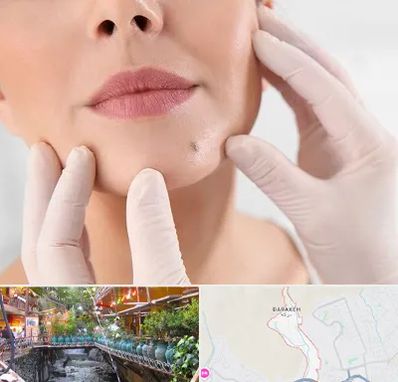 برداشتن خال در درکه