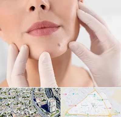 برداشتن خال در قاسم آباد مشهد