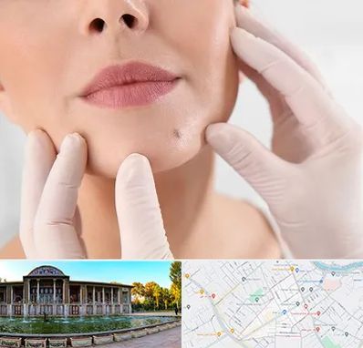 برداشتن خال در عفیف آباد شیراز