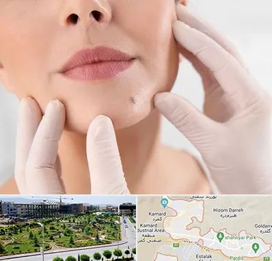 برداشتن خال در پردیس