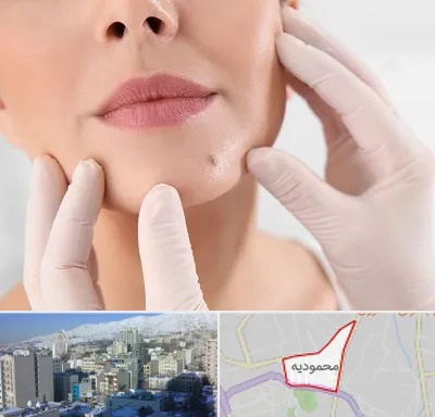 برداشتن خال در محمودیه