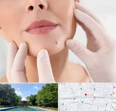 برداشتن خال در هشت بهشت اصفهان