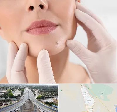 برداشتن خال در اندیمشک