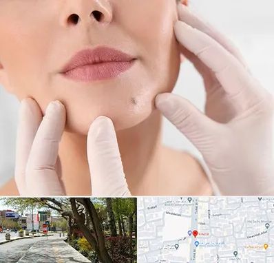 برداشتن خال در خیابان توحید اصفهان