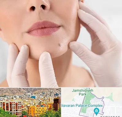 برداشتن خال در نیاوران 