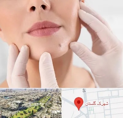 برداشتن خال در شهرک گلستان