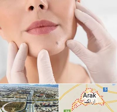 برداشتن خال در اراک