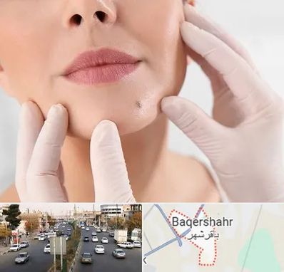 برداشتن خال در باقرشهر