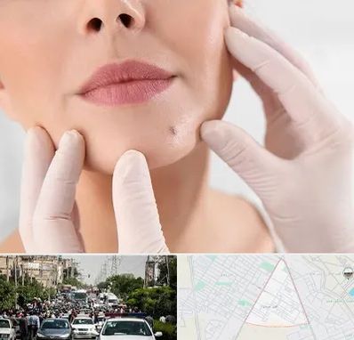 برداشتن خال در سیدی مشهد