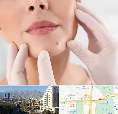 برداشتن خال در حقانی