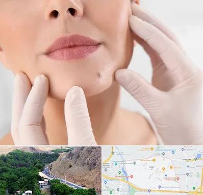 برداشتن خال در کن