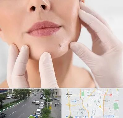 برداشتن خال در ستارخان 