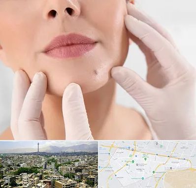 برداشتن خال در منطقه 8 تهران