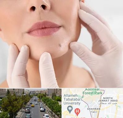 برداشتن خال در شهران 