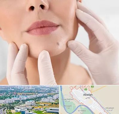 برداشتن خال در آبادان