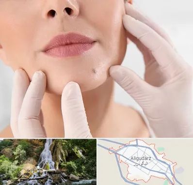 برداشتن خال در الیگودرز