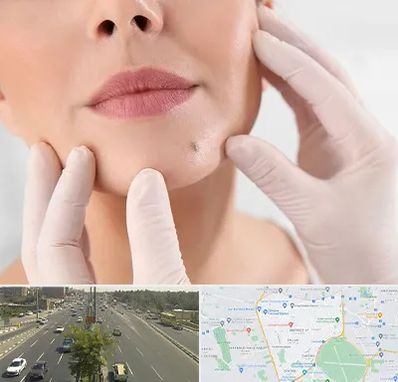 برداشتن خال در منطقه 17 تهران