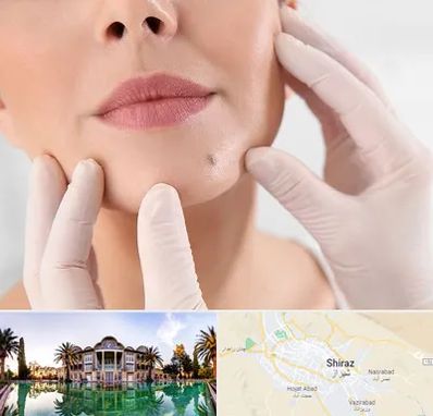 برداشتن خال در شیراز