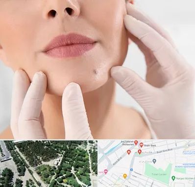 برداشتن خال در سالاریه قم