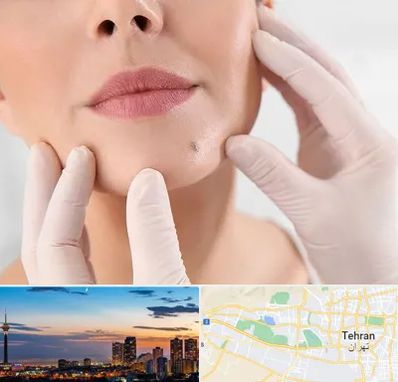 برداشتن خال در غرب تهران 