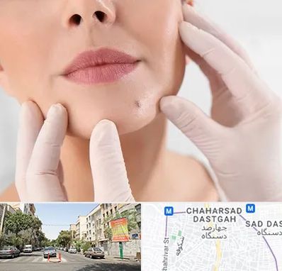 برداشتن خال در چهارصد دستگاه 