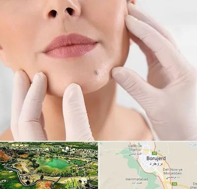 برداشتن خال در بروجرد