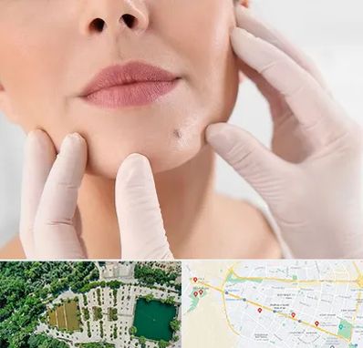 برداشتن خال در وکیل آباد مشهد