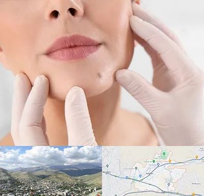 برداشتن خال در رودهن